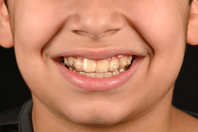 invisalign-for-kids1 invisalign-for-kids1
