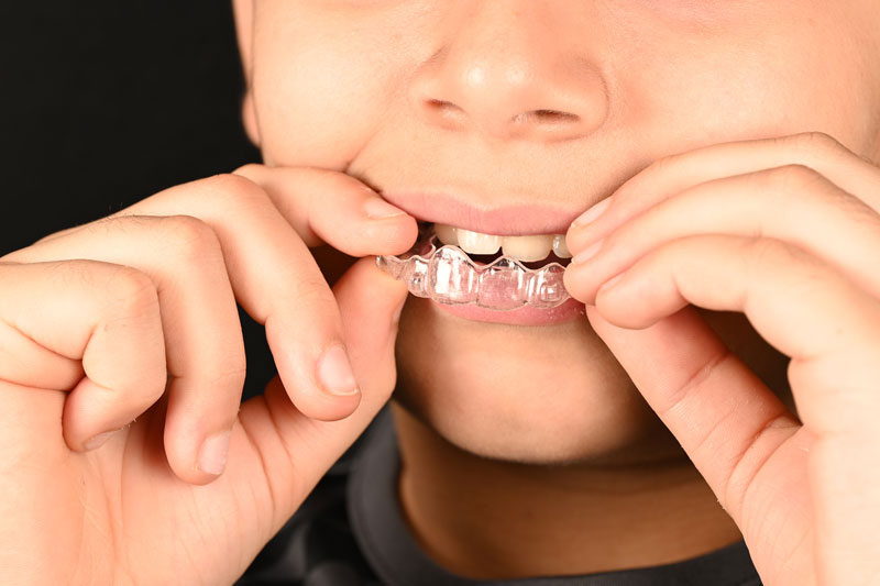 invisalign-for-kids6 invisalign-for-kids6