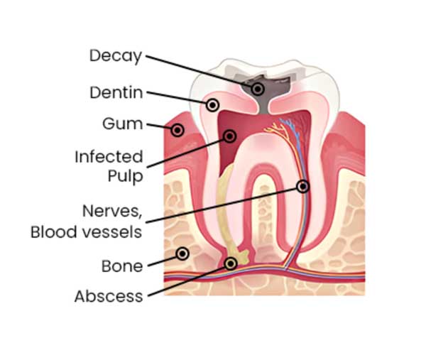 root-canal-treatment-mumbai1 root-canal-treatment-mumbai1