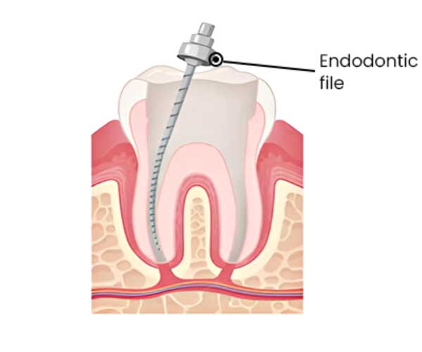 root-canal-treatment-mumbai3 root-canal-treatment-mumbai3