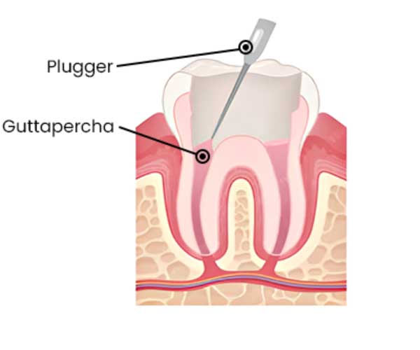 root-canal-treatment-mumbai4 root-canal-treatment-mumbai4