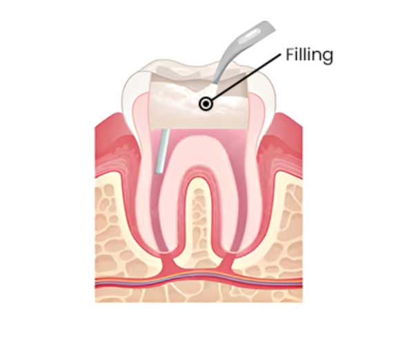 root-canal-treatment-mumbai5 root-canal-treatment-mumbai5