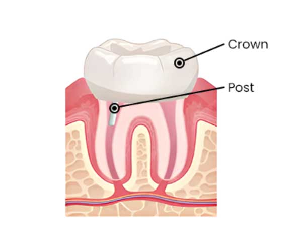 root-canal-treatment-mumbai6 root-canal-treatment-mumbai6