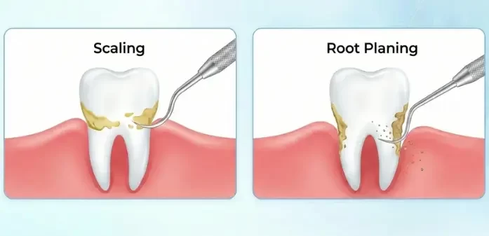 Scaling and Root Planing (1) what is Scaling and Root Planing