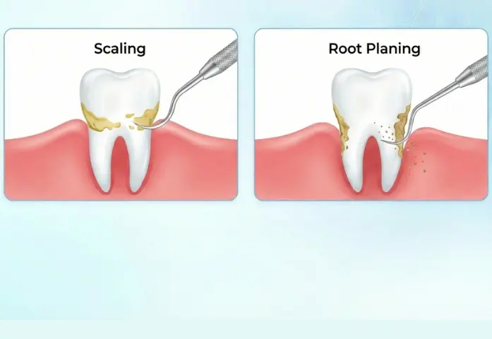 Scaling and Root Planing