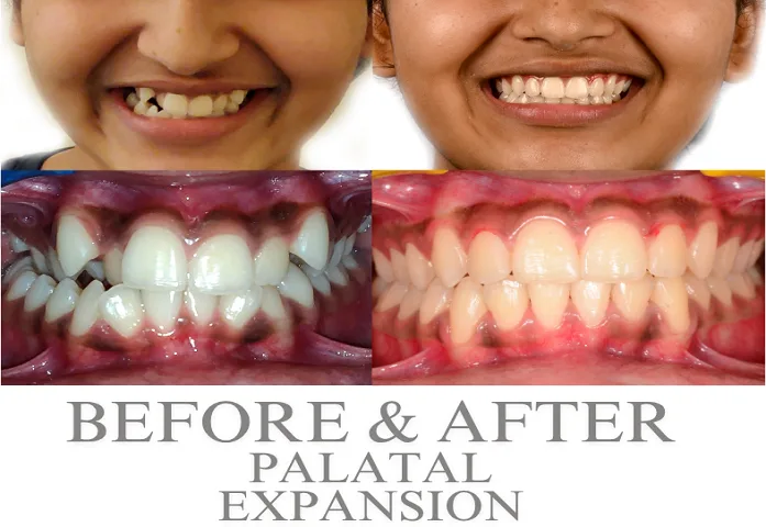 Palatal expander before and after