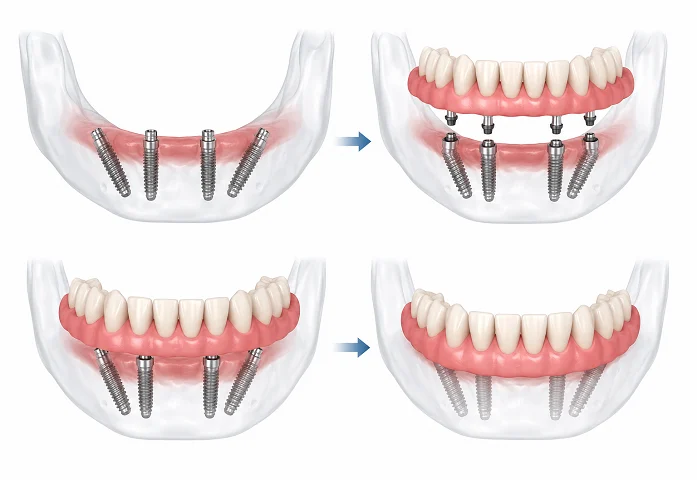 All-on-4 Dental Implants All-on-4 Dental Implants