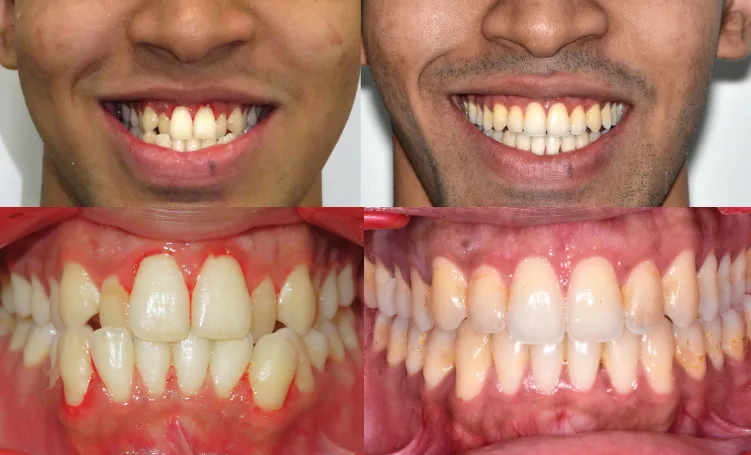 MARPE palatal expansion before and after