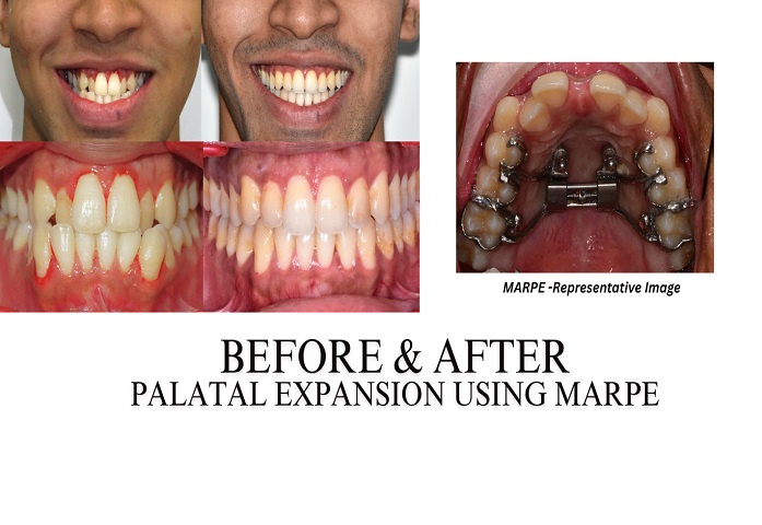 marpe palatal expansion result What is MARPE