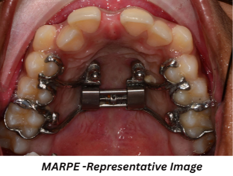 MARPE palatal expansion