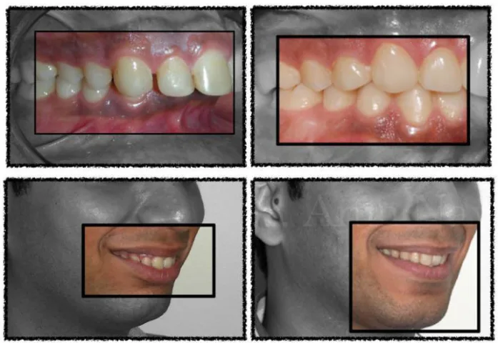 Small Jaw in Adults Small Jaw in Adults