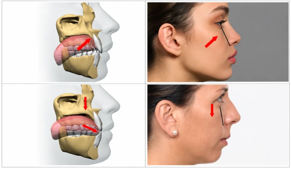 Tongue Posture and Facial Profile Comparison Tongue Posture and Facial Profile Comparison