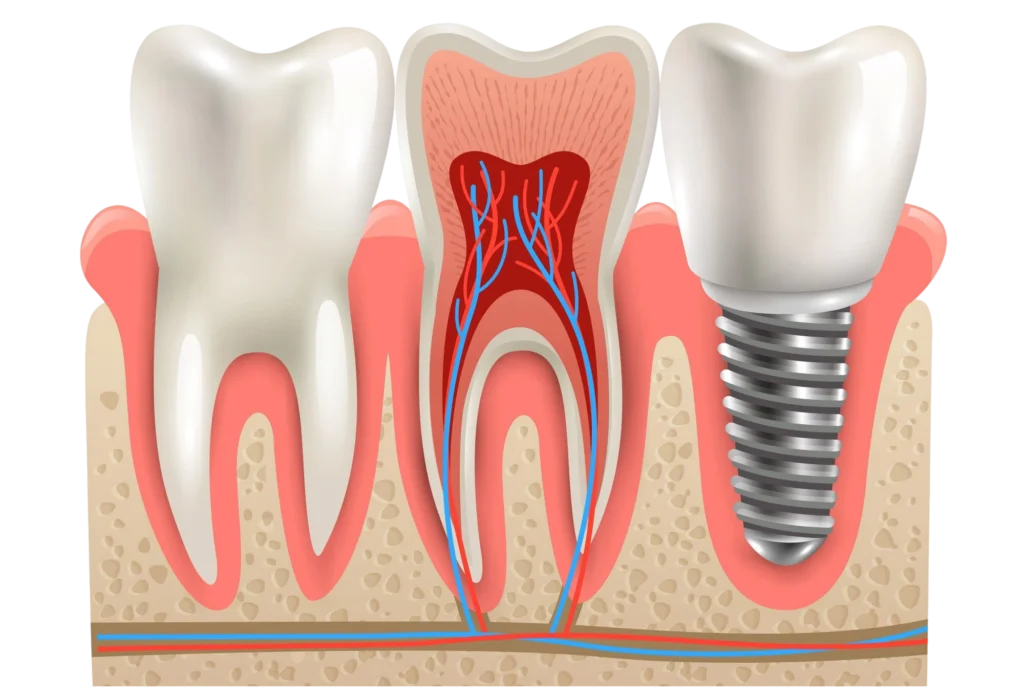 dental-implants-anatomy-closeup-model dental implants anatomy model