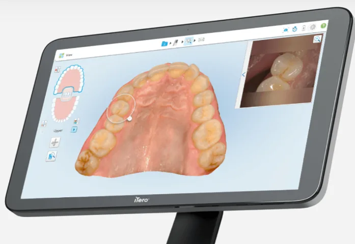Digital Intraoral Scanning Screen Intraoral Scanner at Fort Dental Clinic